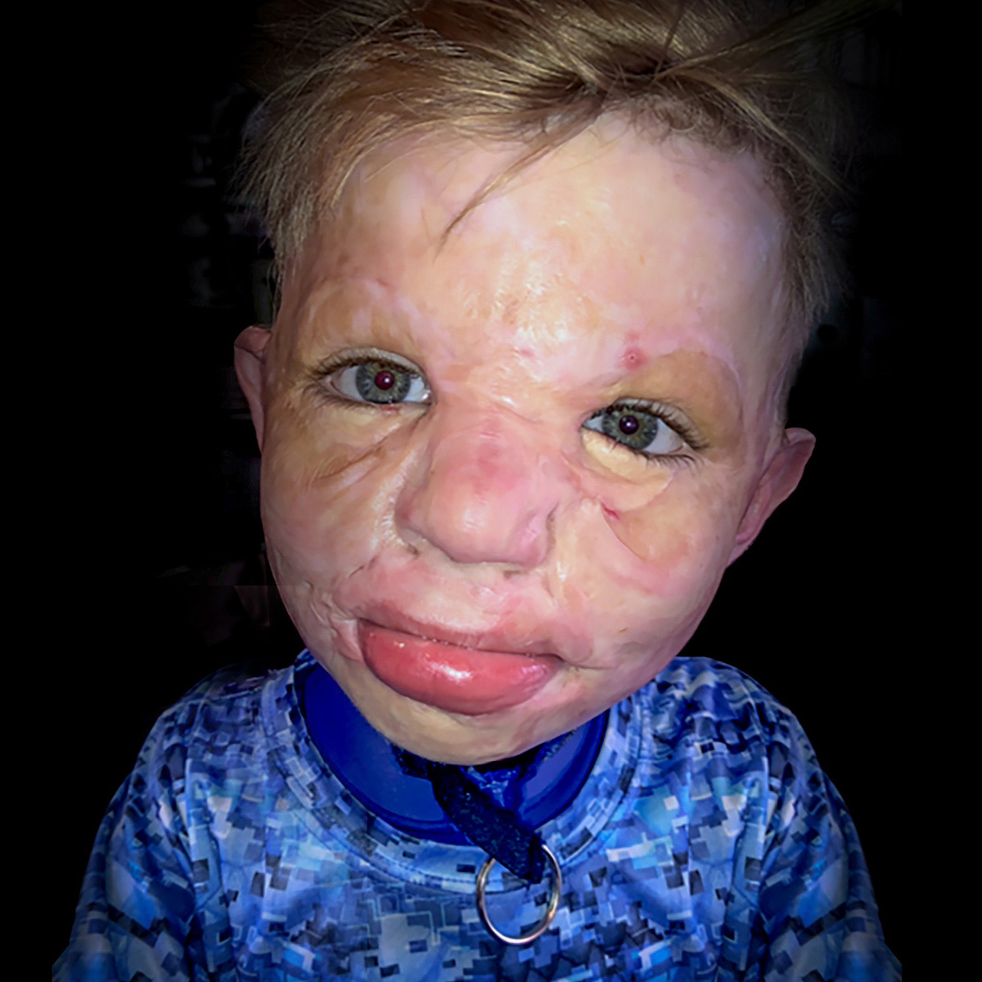 Ronald Weaver, 7 Year Old Burn Survivor