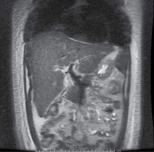Magnetic resonance cholangiopancreatography showing no evidence of intrahepatic bile duct dilation. Bile duct is normal in caliber and only periportal edema was appreciated.