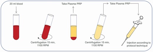 Illustration of platelet-rich plasma preparation by centrifugation.