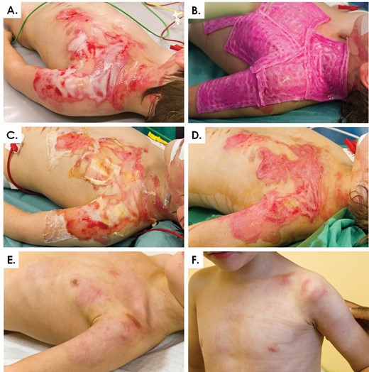 Photographic illustration of pediatric thermal burn wound (scalding injury) evolution after clinical application of PBBs. Second degree superficial and deep burns covered 12% of the TBSA. (A) Aspect of the burns after thorough cleaning and washing. (B) Application of PBBs the next day. (C) Aspect of the burns 48 hours after treatment initiation. (D) Aspect of the burns 4 days after treatment initiation. (E and F) Aspect of the burns 6 weeks after treatment initiation. Full structural and functional recovery were attained, without formation of scar tissue. PBB, Progenitor Biological Bandages. Adapted with permission.66